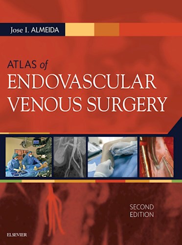 E-book Atlas of Endovascular Venous Surgery