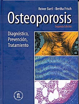 Papel Osteoporosis. Diagnóstico, Prevención y Tratamiento