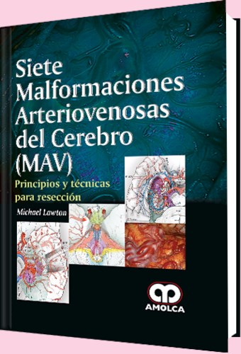 Papel Siete Malformaciones Arteriovenosas del Cerebro (MAV)