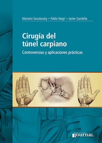 Síndrome del túnel carpiano  Neurocirugía Avanzada Barcelona