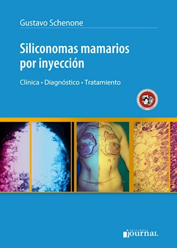 Papel Siliconomas mamarios por inyección