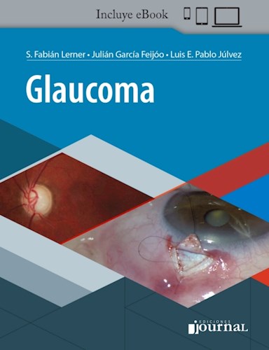 E-Book Glaucoma (eBook)