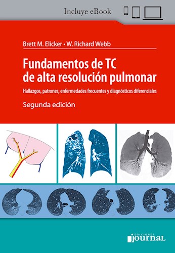 E-Book Fundamentos de TC de Alta Resolución Pulmonar (eBook)